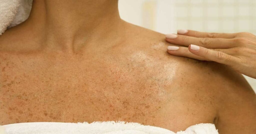 Are There Other Types of Folliculitis?